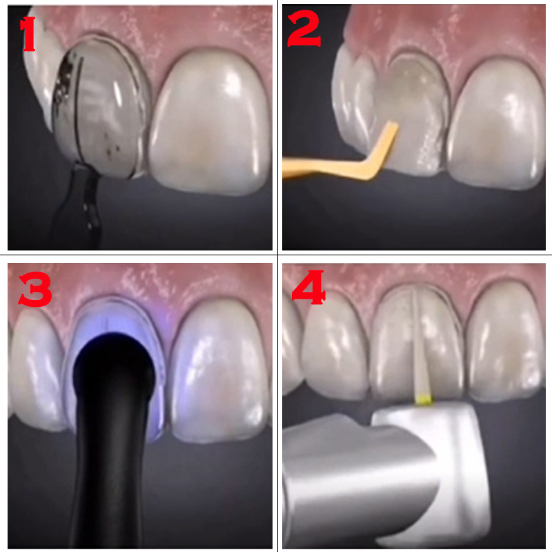 高温滅菌可能な歯科用ベニア型。前歯の審美性を高めるためのベニ - Teeth Whitening Quick のレビューと価格